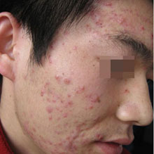 脸上出现痘痘到底哪些原因导致