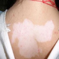 导致白癜风有哪些病因