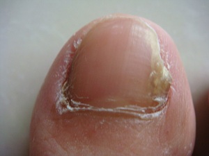 灰指甲有哪些致病的伤害?