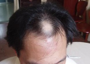 怎样治疗脱发的问题