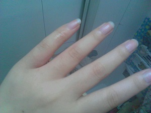 患上湿疹的基本因素有哪些