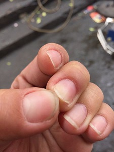 灰指甲的类型有哪些