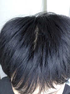 警惕脱发带来的危害有哪些