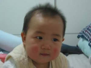 药疹的主要症状有哪些