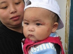 新生儿湿疹的症状有哪些