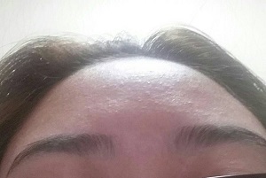 青春痘有哪些发病特点