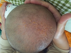 小孩子出现皮炎要怎样预防