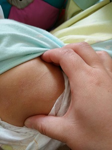 婴幼儿湿疹需要怎样预防