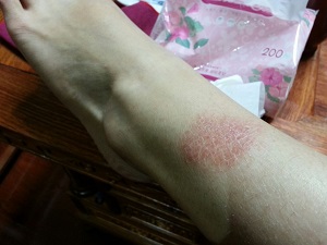 鱼鳞病有哪些基本因素