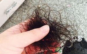女性经常脱发有哪些病因
