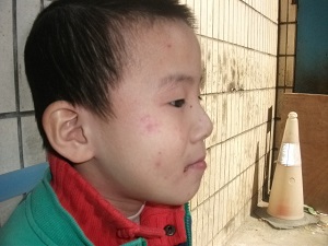 皮炎早期会有哪些症状