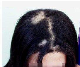 男性为什么会患上脱发