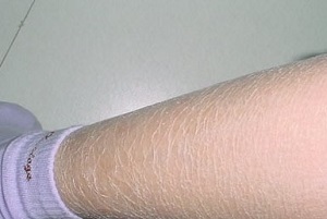 鱼鳞病会有哪些不良影响