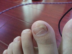 先天性灰指甲会有哪些症状